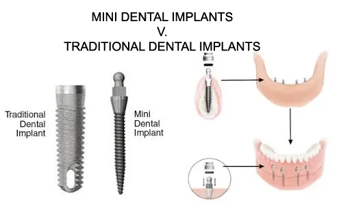 mini dental implants